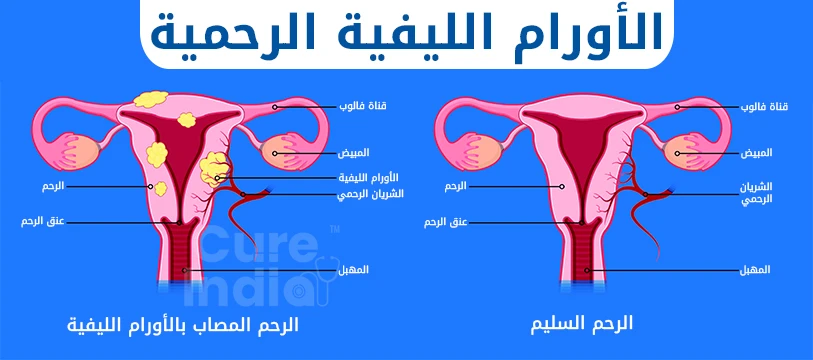 ما هو الورم الليفي الرحمي